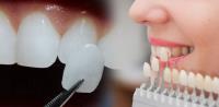 Teeth Whitening in Melbourne image 1