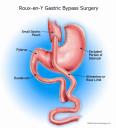  Laparoscopic Gastric Bypass Surgery in India logo