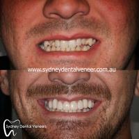 Sydney Dental Veneers image 5
