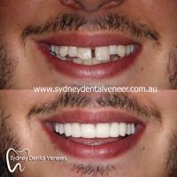 Sydney Dental Veneers image 4