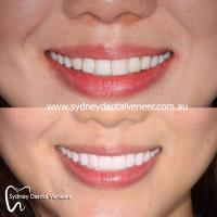 Sydney Dental Veneers image 3
