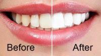 Teeth Whitening Tools image 4