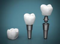 Affordable Dental Implant in Melbourne image 1