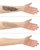 The Tattoo Removal Specialist in Melbourne image 4