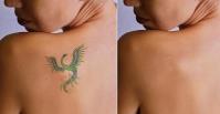 The Tattoo Removal Specialist in Melbourne image 3