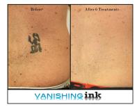 Vanishing Ink Tattoo Removal Clinic image 5