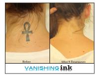 Vanishing Ink Tattoo Removal Clinic image 6