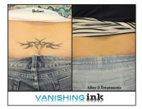 Vanishing Ink Tattoo Removal Clinic image 2