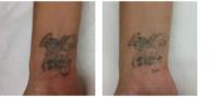 Second Thoughts Tattoo Removal image 5