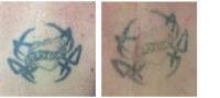 Second Thoughts Tattoo Removal image 6