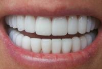 Traditional Metal Braces - Best Smile Orthodontist image 4