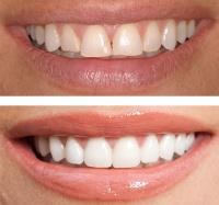 Traditional Metal Braces - Best Smile Orthodontist image 5