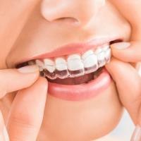 Traditional Metal Braces - Best Smile Orthodontist image 7