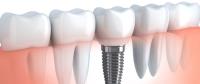 Best Hcf Dentist - Hawthorn East Dental image 2