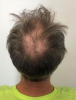 CRLab Australia - Hair Loss Scalp Clinic image 3