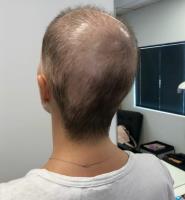 CRLab Australia - Best Female Hair Loss Treatment image 7