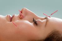 Natural Solutions Acupuncture image 1