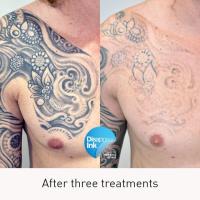 Disappear Laser Clinic + Tattoo Removal image 2