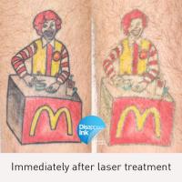 Disappear Laser Clinic + Tattoo Removal image 5
