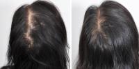 The Crown Clinic | Hair Transplant in Melbourne image 2