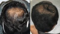 The Crown Clinic | Hair Transplant in Melbourne image 3