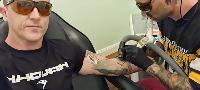 Counterpunch Tattoo Removal image 3