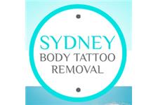Sydney Laser Tattoo Removal image 1