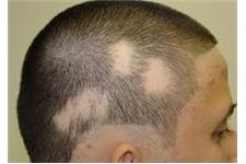PRP for Hair Loss image 2