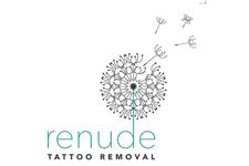 Renude Laser Tattoo Removal image 1