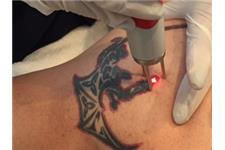 Renude Laser Tattoo Removal image 3