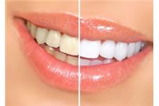 Oracle Dental - Teeth Veneers, Crowns, Straightening &  Whitening image 4