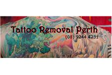 Tattoo Removal Perth image 1