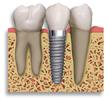 Ipswich and Brisbane Dental Implants and Cosmetic Dentistry image 3