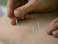 BMBS Acupuncture @ Head 2 Toe Health image 2