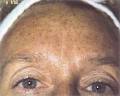 Maram's Clinic Laser IPL Hair Removal image 4