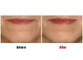 Suppelle Cosmetic Injections image 2