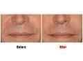 Suppelle Cosmetic Injections image 4