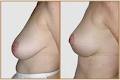 Sydney Breast Reduction Institute image 3