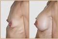Sydney Breast Reduction Institute image 1