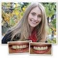 GlamSmile - Dental Porcelain Veneers image 2