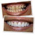 GlamSmile - Dental Porcelain Veneers image 3