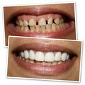 GlamSmile - Dental Porcelain Veneers image 5