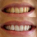 Mobile Teeth Whitening Gold Coast Snow White image 3