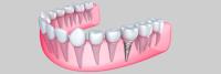 Dental Bridges Hoppers Crossing image 5