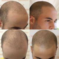 Novoscalp Micropigmentation Clinic image 1