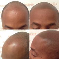 Novoscalp Micropigmentation Clinic image 5