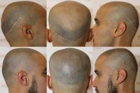 Novoscalp Micropigmentation Clinic image 7