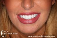 Sydney Dental Veneers image 6