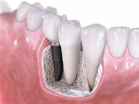 Best Place For Dental Implant in Melbourne image 3