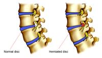 Herniated Disc Treatment image 1